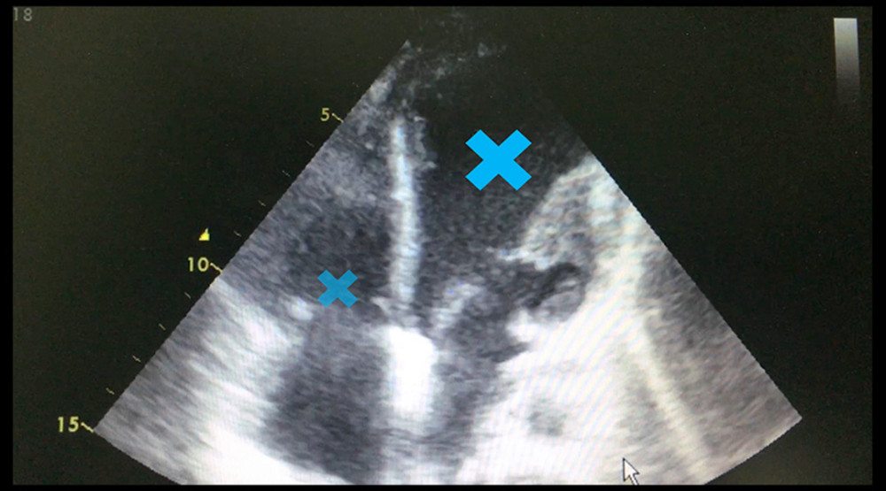 Echocardiography, showing apical ballooning of the left ventricle with akinesia, as well as thickened tricuspid leaflets with severe tricuspid regurgitation (blue cross).