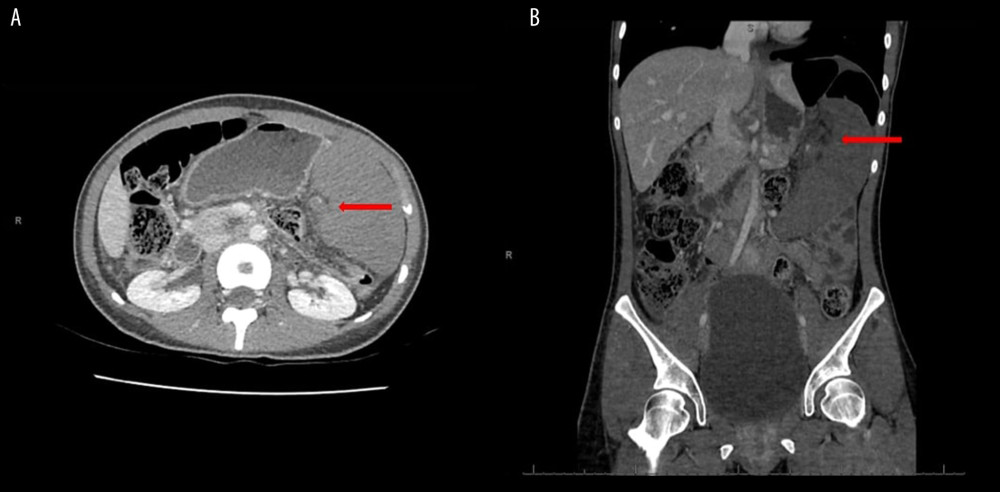 Computed tomography images with arrows demonstrating a splenomegaly associated with spleen hypoperfusion. Axial (A) and coronal (B) reconstruction planes.