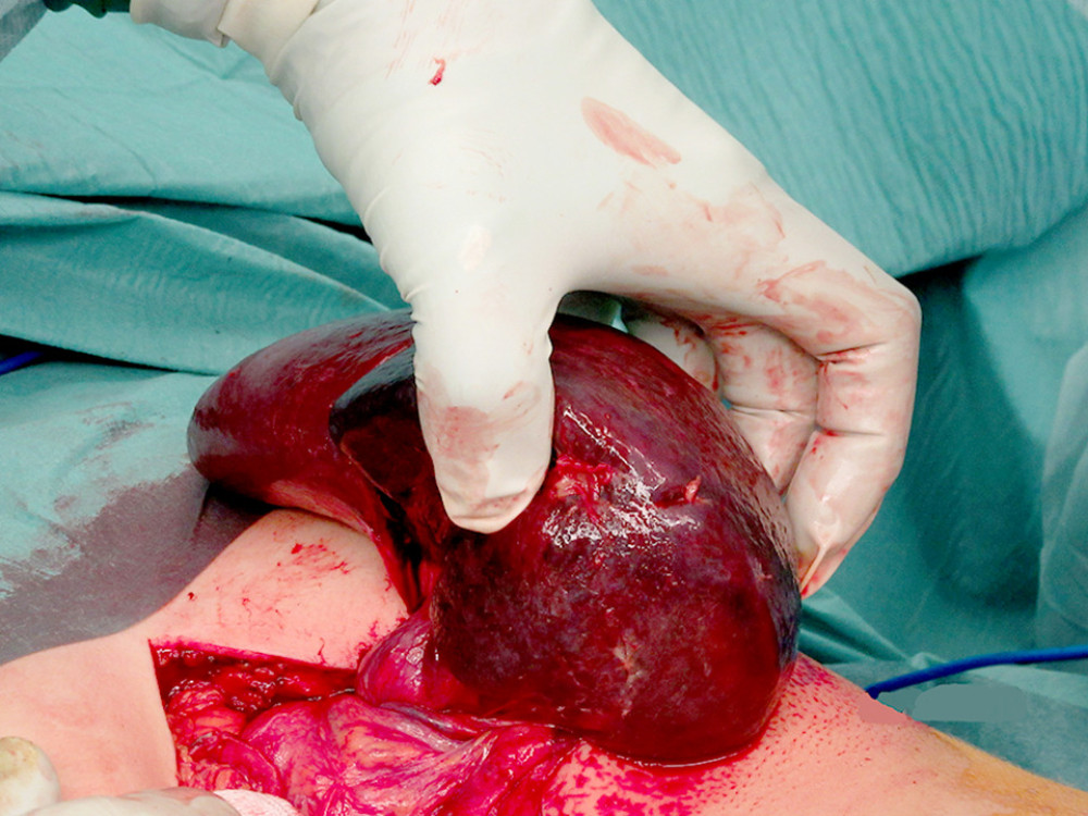 Torsion of the splenic vascular pedicle responsible for an ischemic necrosis of the spleen.