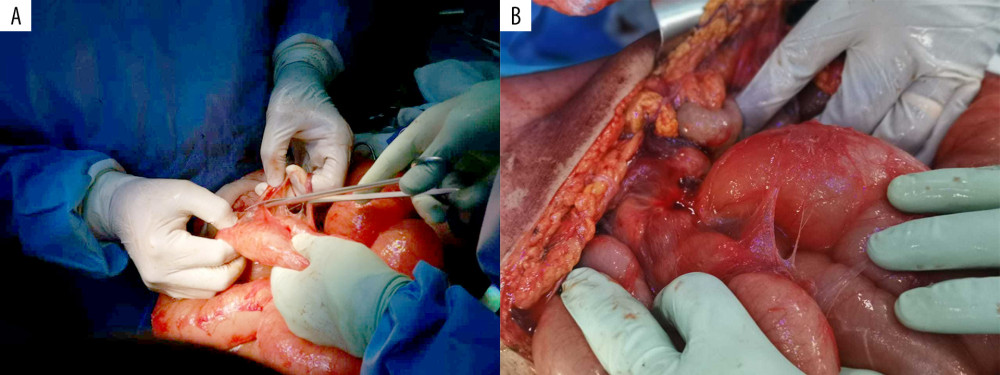 Macroscopic appearance of encapsulating peritoneal sclerosis. (A) Partial cocooning of the terminal ileum. (B) Adhesiolysis.