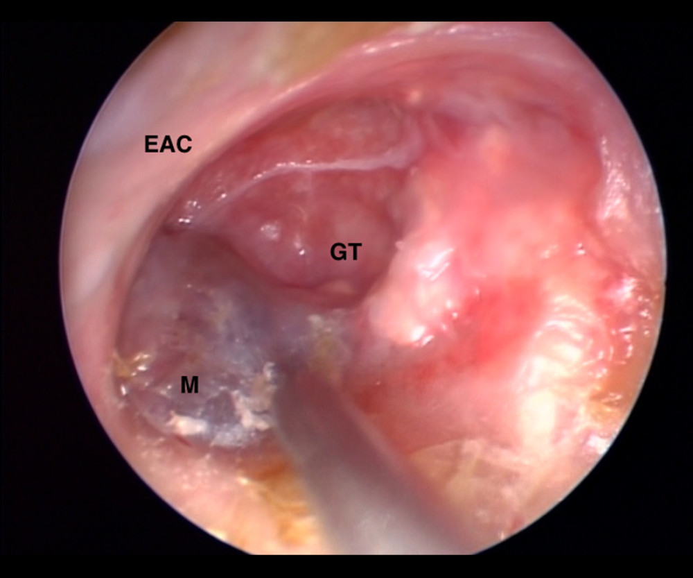Endoscopic vision of the mass (M), external auditory canal (EAC), granulation tissue (GT) on the tympanic membrane.