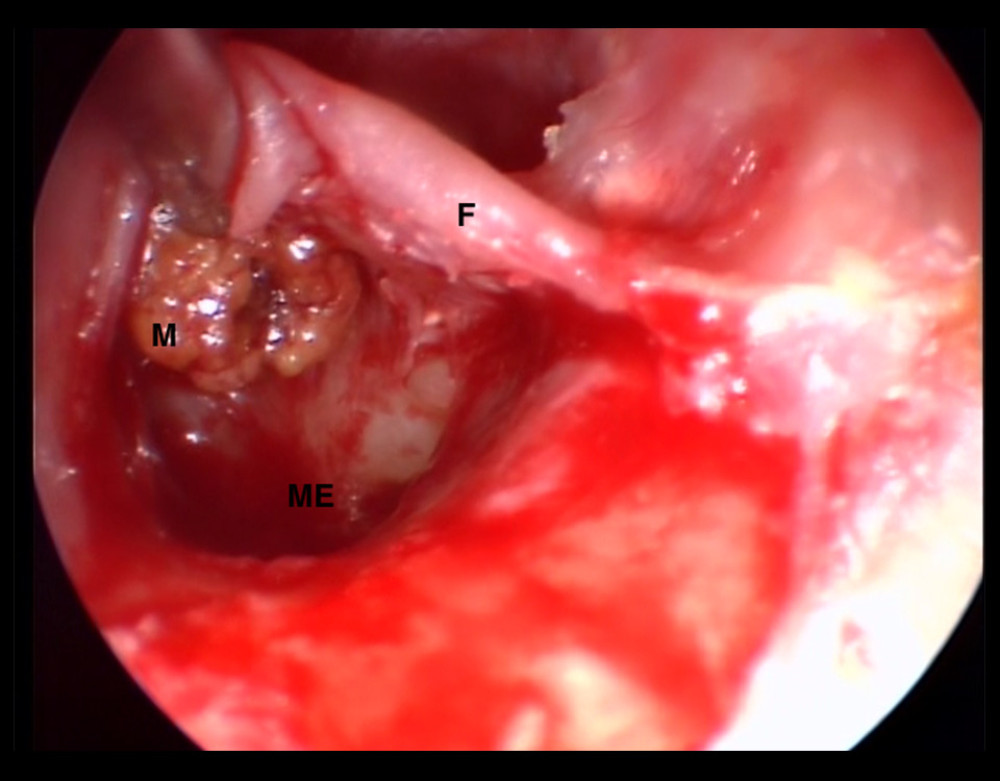 Intraoperative view during mass excision (M), middle ear (ME), tympanomeatal flap (F).