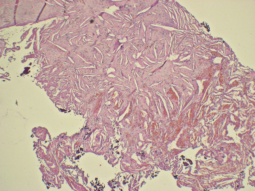 Cholesterol granuloma. Connective tissue deepithelialized with some capillary-size blood vessels, numerous cholesterol clefts with some foreign body-type giant cells and focal hemorrhage. There are small fragments of bone tissue (hematoxylin and eosin 5×).