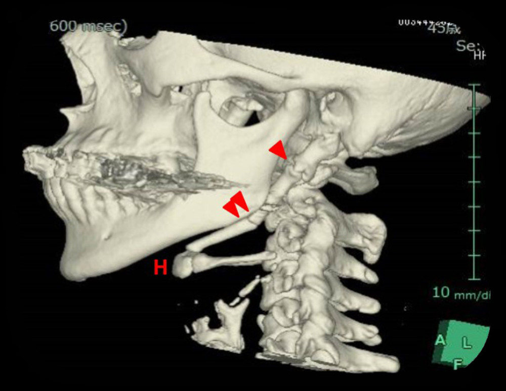 Cervical 3-dimensional computed tomography (3DCT). The styloid process was overly long (~80 mm) and extended to the hyoid bone. The upper fracture (arrow) showed deformation fusion and was considered to be