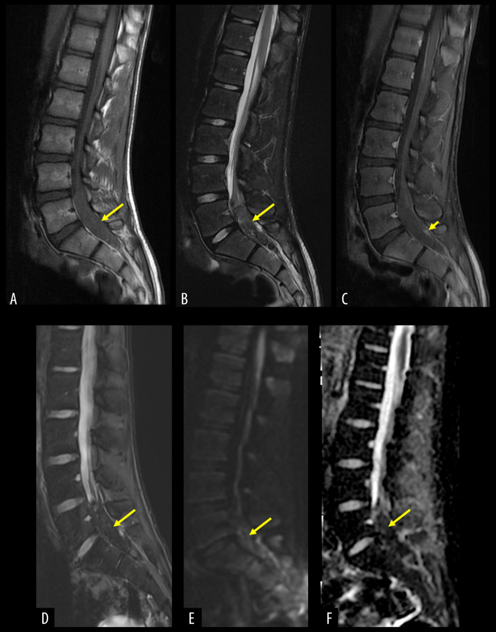 Lumbar spine magnetic resonance imaging. (A) Precontrast sagittal T1WI. (B) Fat-saturated mid-sagittal T2WI. (C) Postcontrast midsagittal T1WI. An intradural lesion can be seen at the levels of L5, S1, and S2. The lesion is isointense on T1WI and heterogeneously hypointense on T2WI. Postcontrast images showed a lack of enhancement except for an enhancing focus at the posterior aspect of the lesion. (D) T2 * sequence showed blooming artifacts indicating hemorrhagic content within the lesion. (E, F) Diffusion-weighted and apparent diffusion coefficient (ADC) sequences showed the corresponding heterogeneous diffusion restriction.