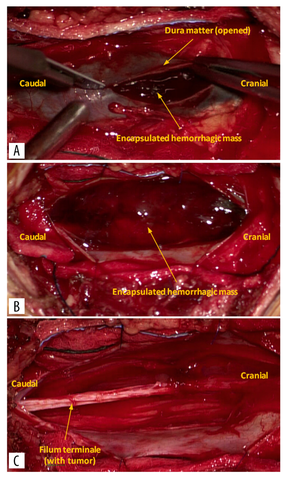 Intraoperative view of lumbosacral hemorrhagic myxopapillary ependymoma (A) during dural opening, (B) after full exposure revealing the encapsulated hemorrhagic mass, and (C) after removal of the tumor.