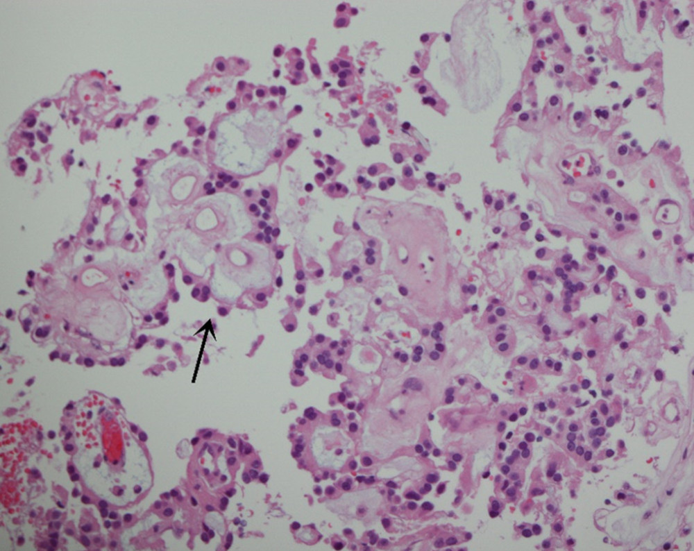 The tumor shows well-differentiated cuboidal to elongated tumor cells radially oriented around vascularized myxoid cores (arrow, hematoxylin and eosin staining, ×200 magnification).