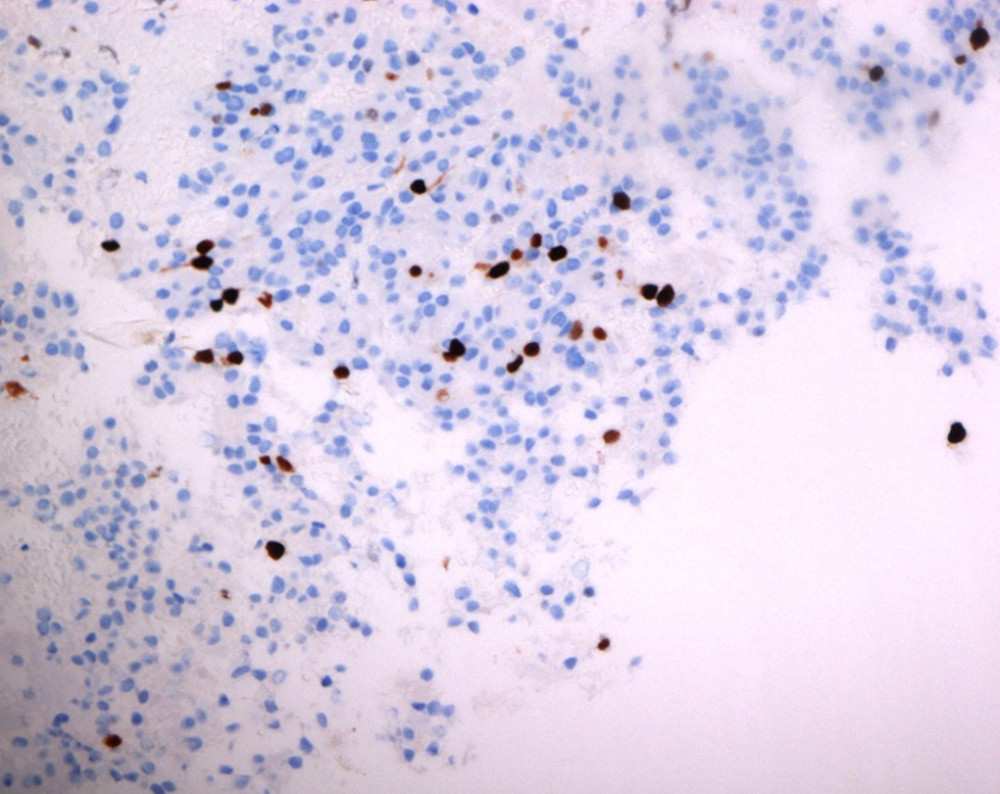 The Ki-67 proliferative index was low but focally increased (up to 8%, Ki-67 staining, ×200 magnification).