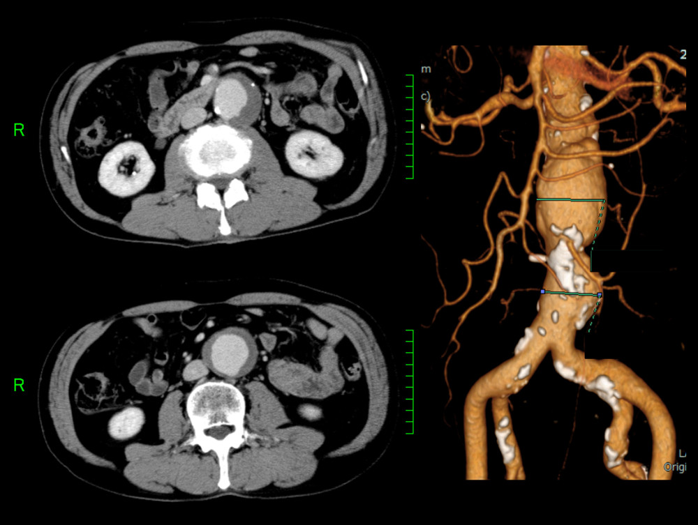 Contrast-enhanced CT scanning revealed an abdominal aortic aneurysm (AAA). The maximum short-axis diameter of the AAA is 44 mm. No evidence of rupture is seen.