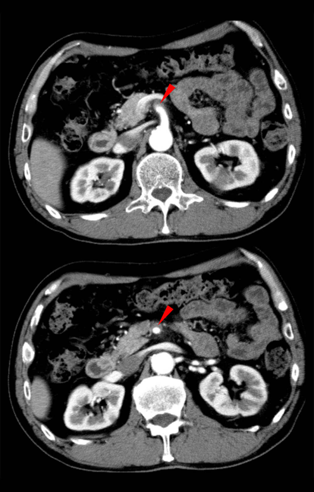 Contrast-enhanced CT scanning showed an superior mesenteric artery dissection (SMAD) without evidence of aortic involvement.