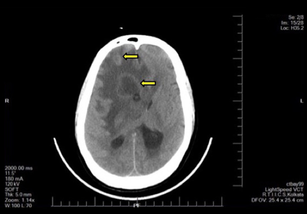 Plain, noncontrast computed tomography scan showing 2 lesions (yellow arrow) in the right frontal lobe, exerting a mass effect. These lesions were suspected to be the abscess.