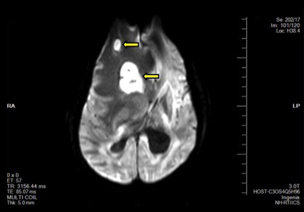 Magnetic resonance imaging of right frontal lobe showing intraparenchymal lesions (yellow arrow) with perilesional edema and mass effect. This image shows the suspected fungal abscess.