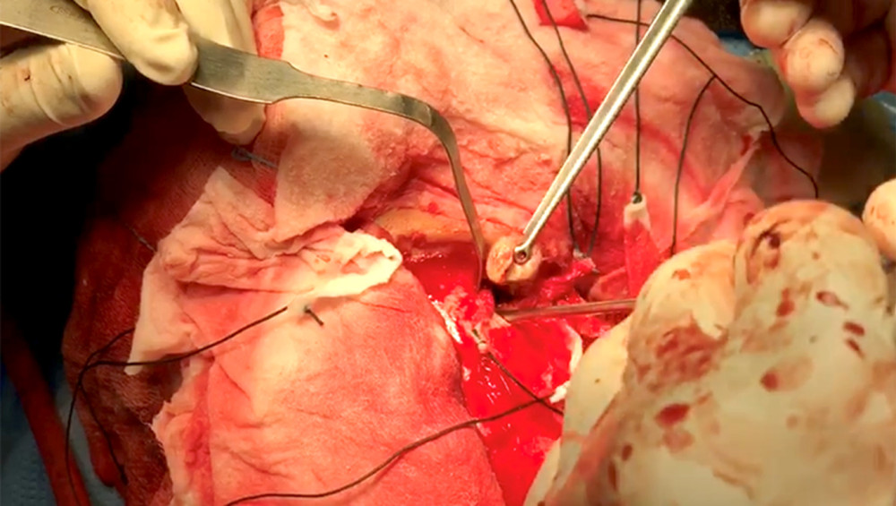 Microsurgical abscess evacuation during partial frontal lobectomy.