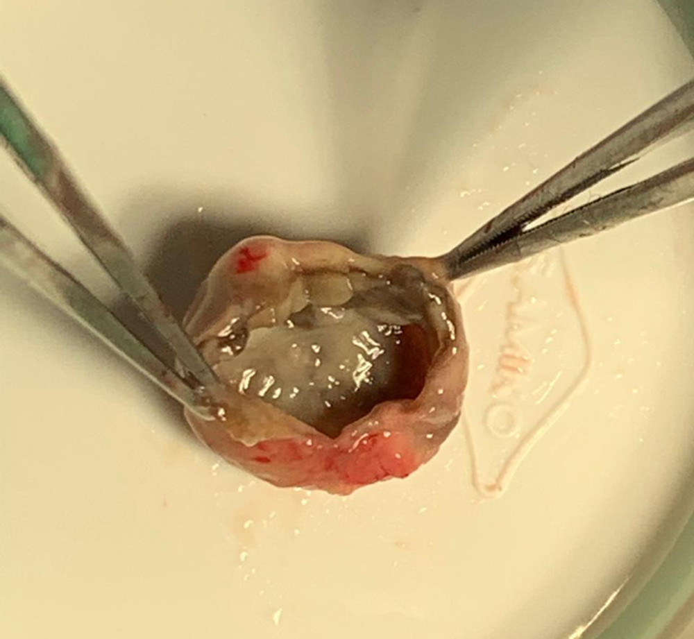 Encapsulated fungal abscess after evacuation.
