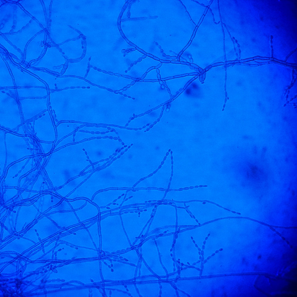 Lactophenol cotton blue mount (at ×48): Septate hyphae with conidiophores bearing long chains of spindle-shaped conidia suggestive of Cladophialophora genus.