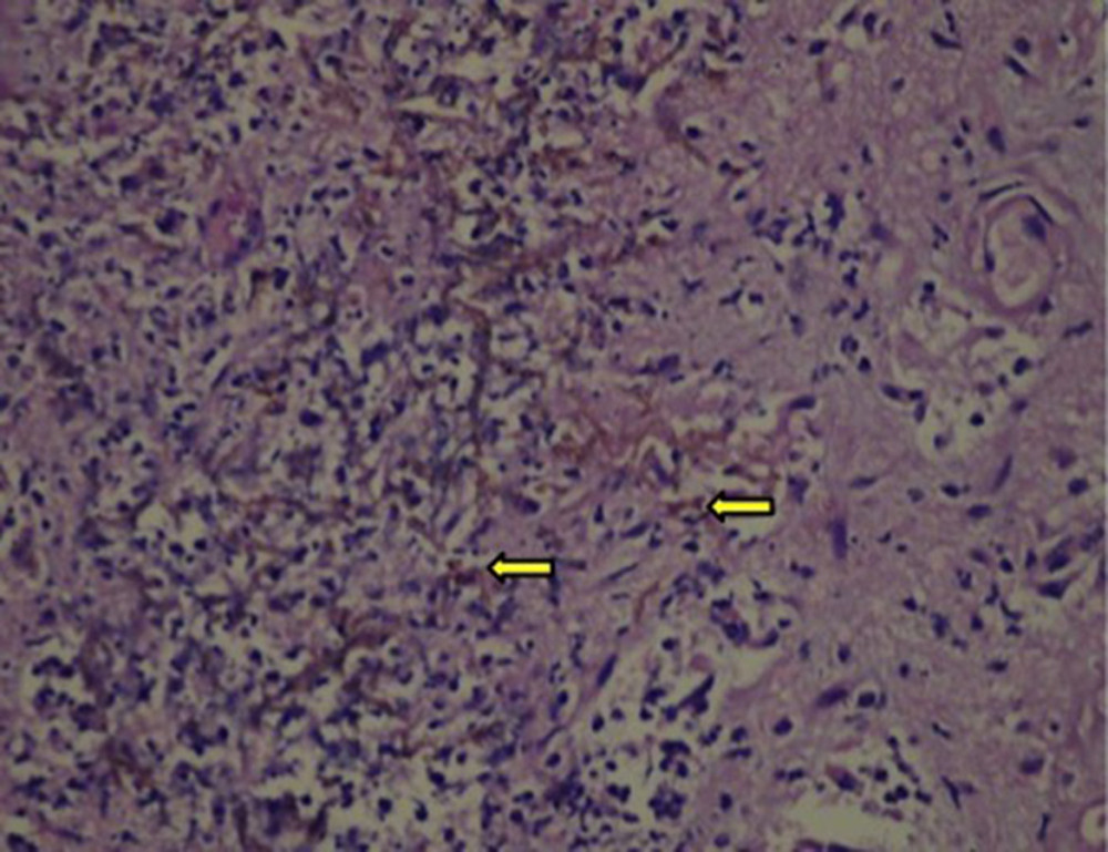 On histopathology, pigmented septate fungal hyphae are visible. Yellow arrows indicate the pigmented fungal bodies (hematoxylin and eosin stain, ×200).