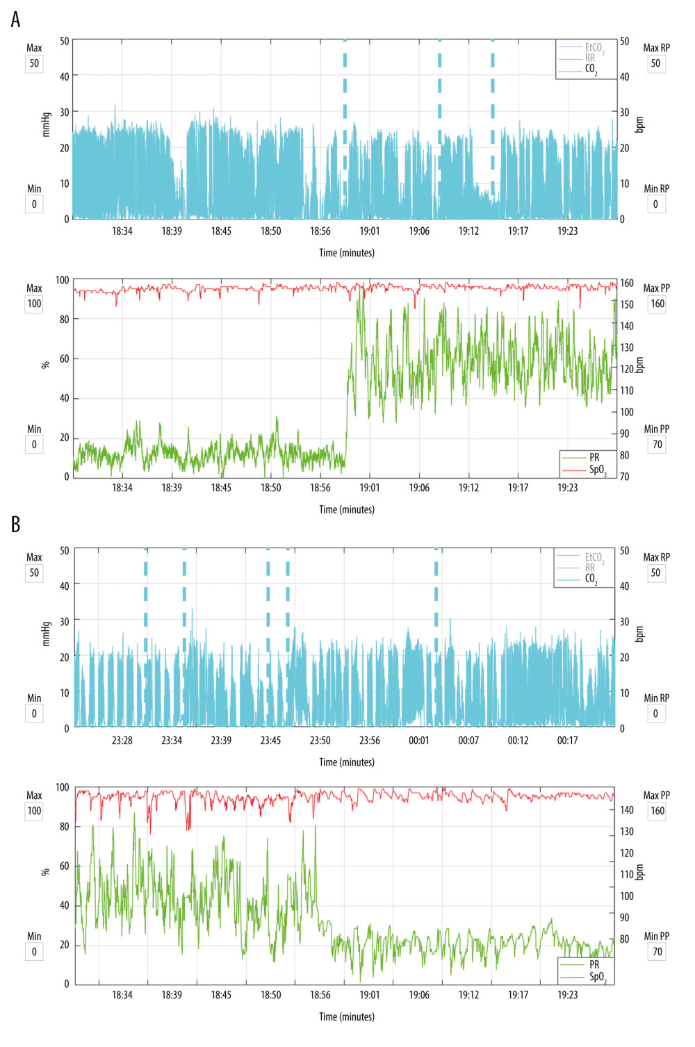 Postoperative abrupt change in heart rate (HR) consistent with atrial fibrillation in a 75-year-old man. The top panel shows exhaled end-tidal carbon dioxide (etCO2, represented by blue lines) measured with the Microstream™ capnography monitor. The dashed blue lines are alerts generated by apneic episodes (no breath detected for >30 s). The bottom panel shows oxyhemoglobin saturation (red line for SpO2) and HR (green line) measured with Nellcor™ pulse oximetry. In figure A, there is an abrupt change in HR from approximately 80 to 90 beats per minute (bpm) to a highly variable rate of 100 to 150 bpm. This change coincides with an apneic episode. In figure B, after 5 hours, there is another abrupt change, with the HR returning to the 80- to 90-bpm range. Also note the intermittent hypoxemic episodes that coincide with apneic episodes. EtCO2 – end-tidal carbon dioxide; RR – respiratory rate; SpO2 – oxyhemoglobin saturation; PR – pulse rate.