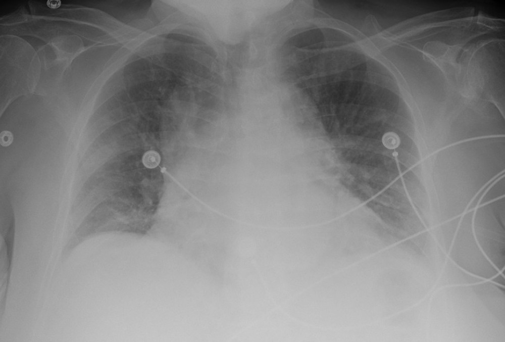 Anteroposterior chest radiograph on day 1 revealed patchy air space opacity in the right upper lobe, suspicious for pneumonia.