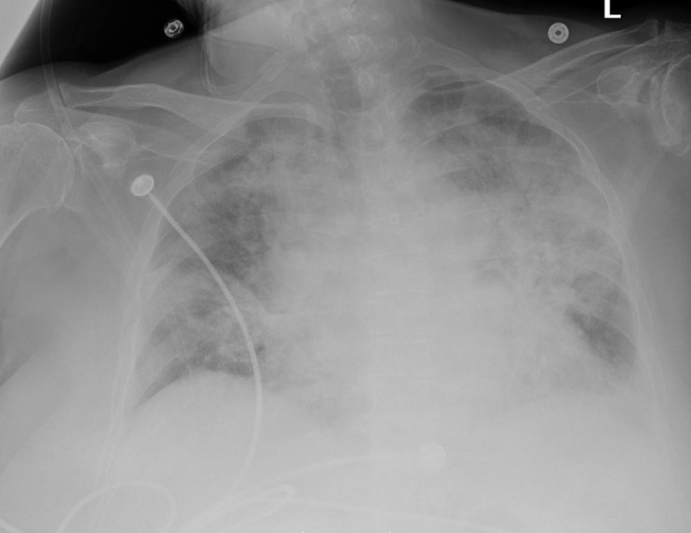 Anteroposterior chest radiograph on day 6 revealed bilateral alveolar infiltrates due to pneumonia and interstitial edema consistent with ARDS.