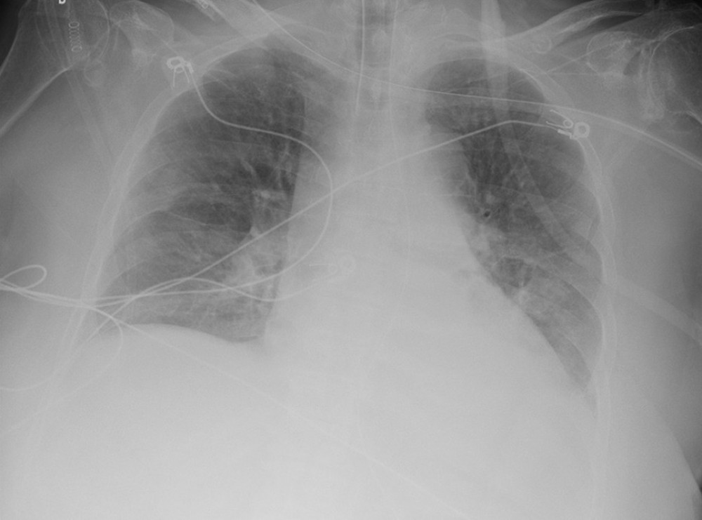 Anteroposterior chest radiograph on day 10 showed significant improved of the bilateral infiltrates and interstitial edema.