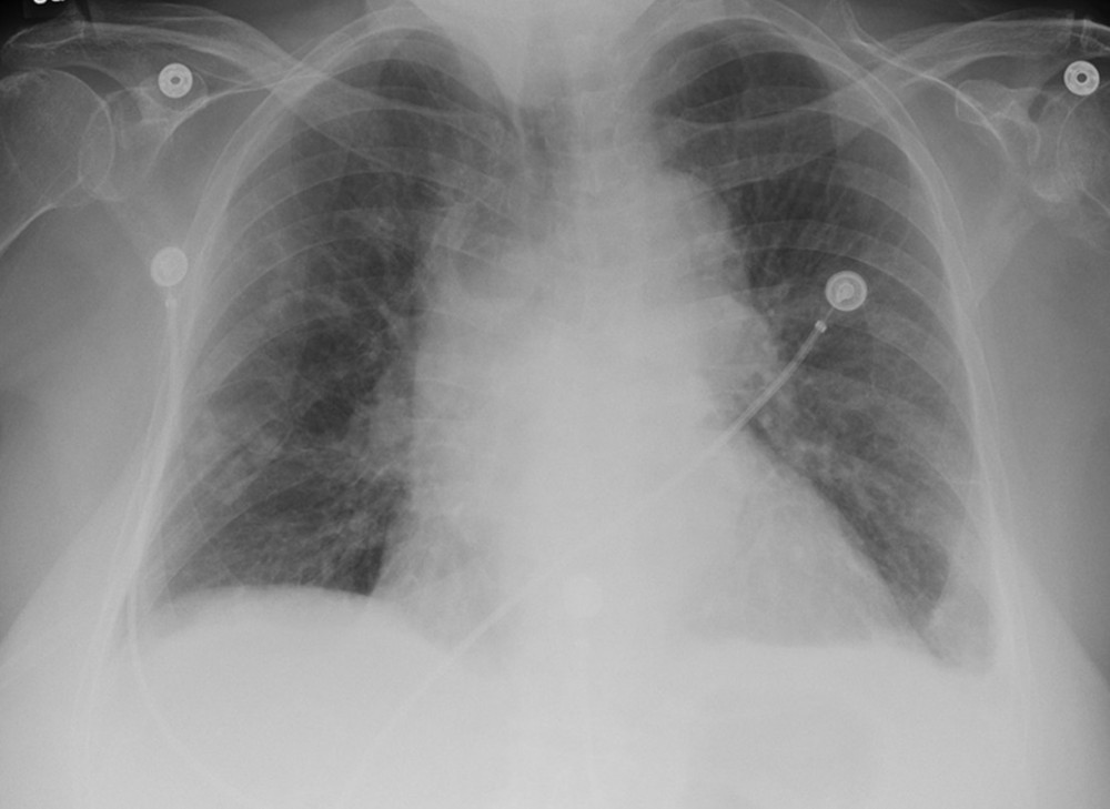 Anteroposterior chest radiograph on day 16 revealed nearly complete resolution of the infiltrates and interstitial edema.