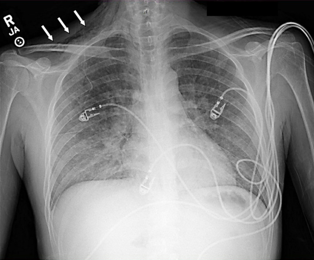 Chest X-ray of the first patient showing subcutaneous emphysema (denoted by arrows) prior to intubation.