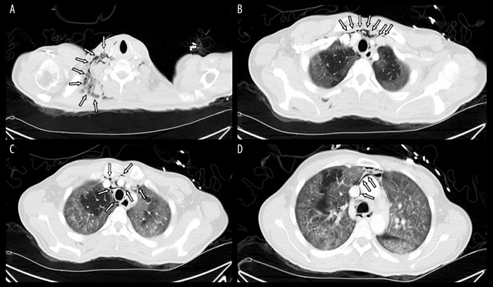 (A–D) Chest computed tomography of the first patient showing subcutaneous emphysema and pneumomediastinum (denoted by arrows).