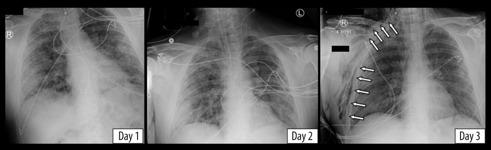 Chest X-rays of the second patient showing new-onset subcutaneous emphysema on day 3 (denoted by arrows).