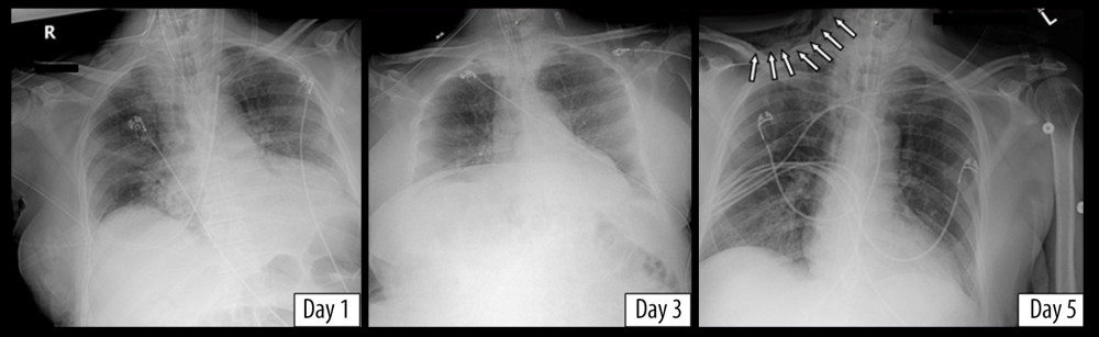 Chest X-rays of the third patient showing new-onset subcutaneous emphysema on day 5 (denoted by arrows).