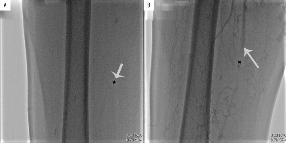 (A) Control film showing a typical appearance of vascular closure device (VCD) with two wings on either side of the plug. (B) Angiogram of the right lower limb illustrating VCD occluding the right superficial femoral artery with collateral development.