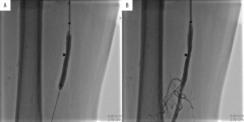 (A) Balloon angioplasty after successful stent deployment. (B) Satisfactory confirmatory angiographic result with mild residual stenosis.