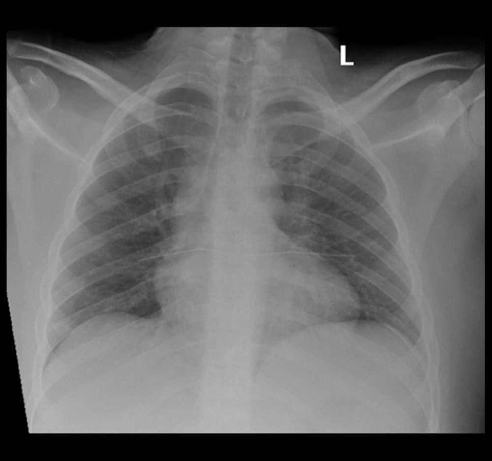 Posterior-anterior radiograph of chest obtained on day of presentation demonstrates no cardiopulmonary disease.