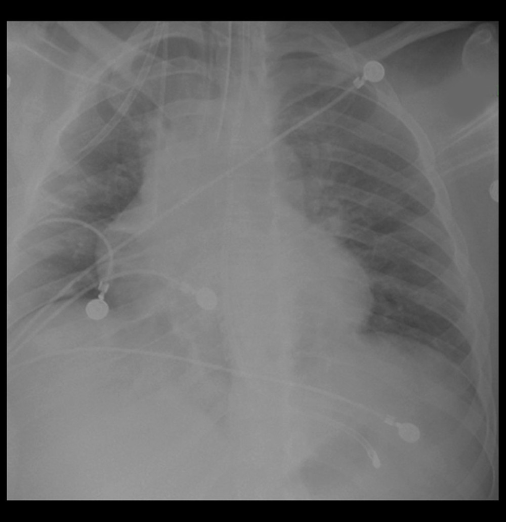 Posterior-anterior radiograph of chest obtained on day 2 of hospital stay demonstrates minimal perihilar patchy areas of opacity on the right with increased vascular markings on the left.