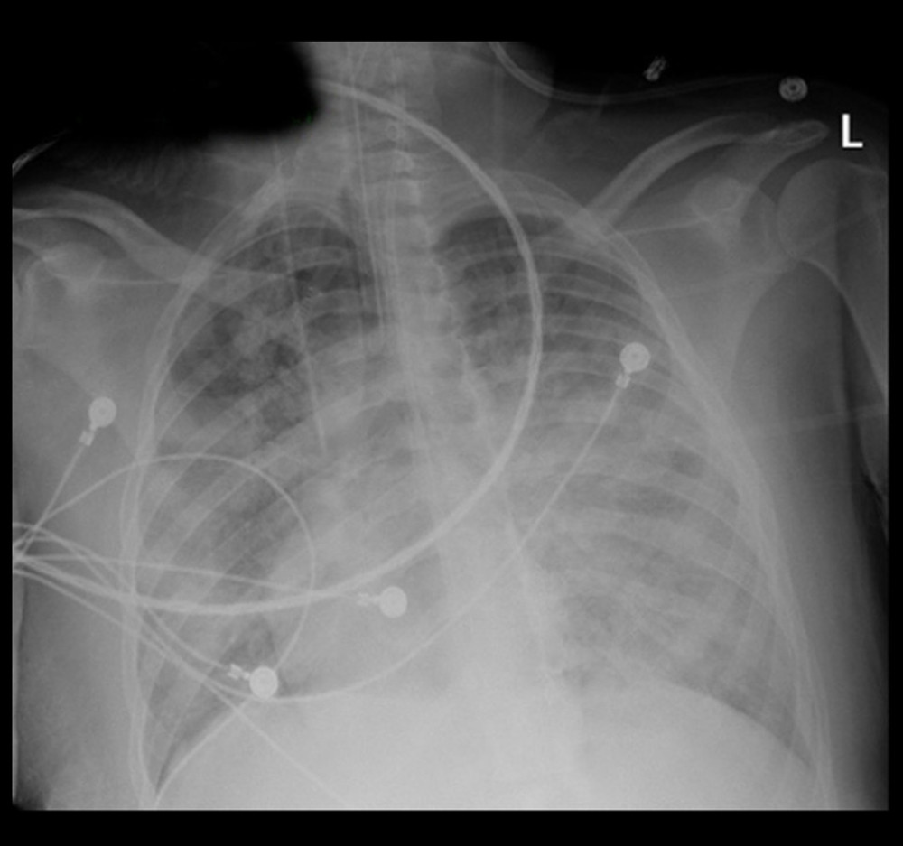 Posterior-anterior radiograph of chest obtained on day 8 of stay demonstrates diffuse fluffy infiltrates throughout both lungs consistent with acute respiratory distress syndrome (ARDS).