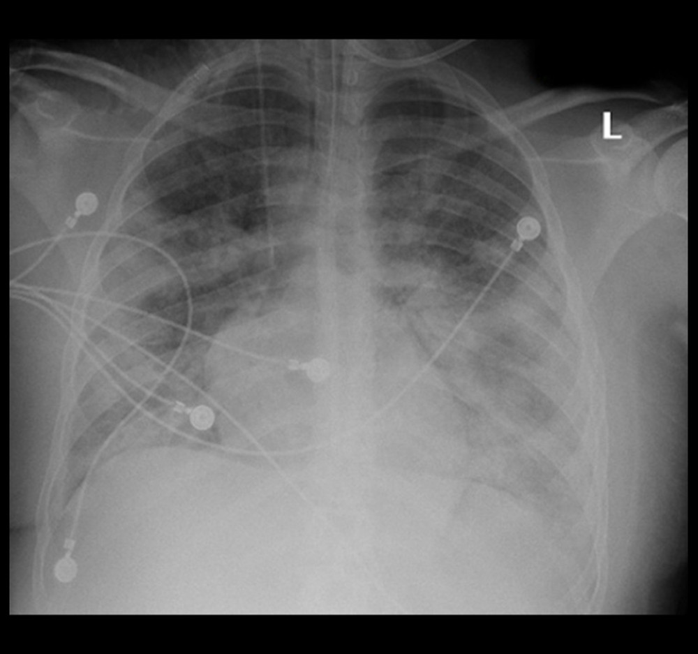 Posterior-anterior radiograph of chest obtained on day 9 of stay demonstrates bilateral diffuse infiltrates.