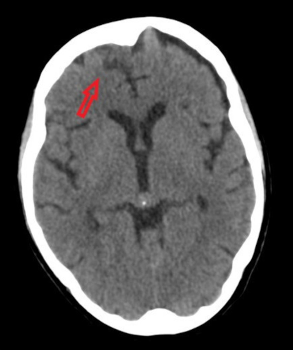 A direct brain computed tomography scan section showing the isodense right dural parafalcine nodular lesion (dimensions: 0.9×1.6 cm).