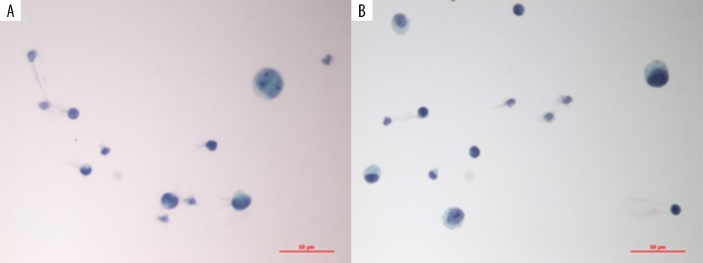 (A, B) Microphotographs from microscopic examination of the cerebrospinal fluid sample. Signet ring cells are clearly recognizable (method: liquid-based cytology, Papanicolaou stain).