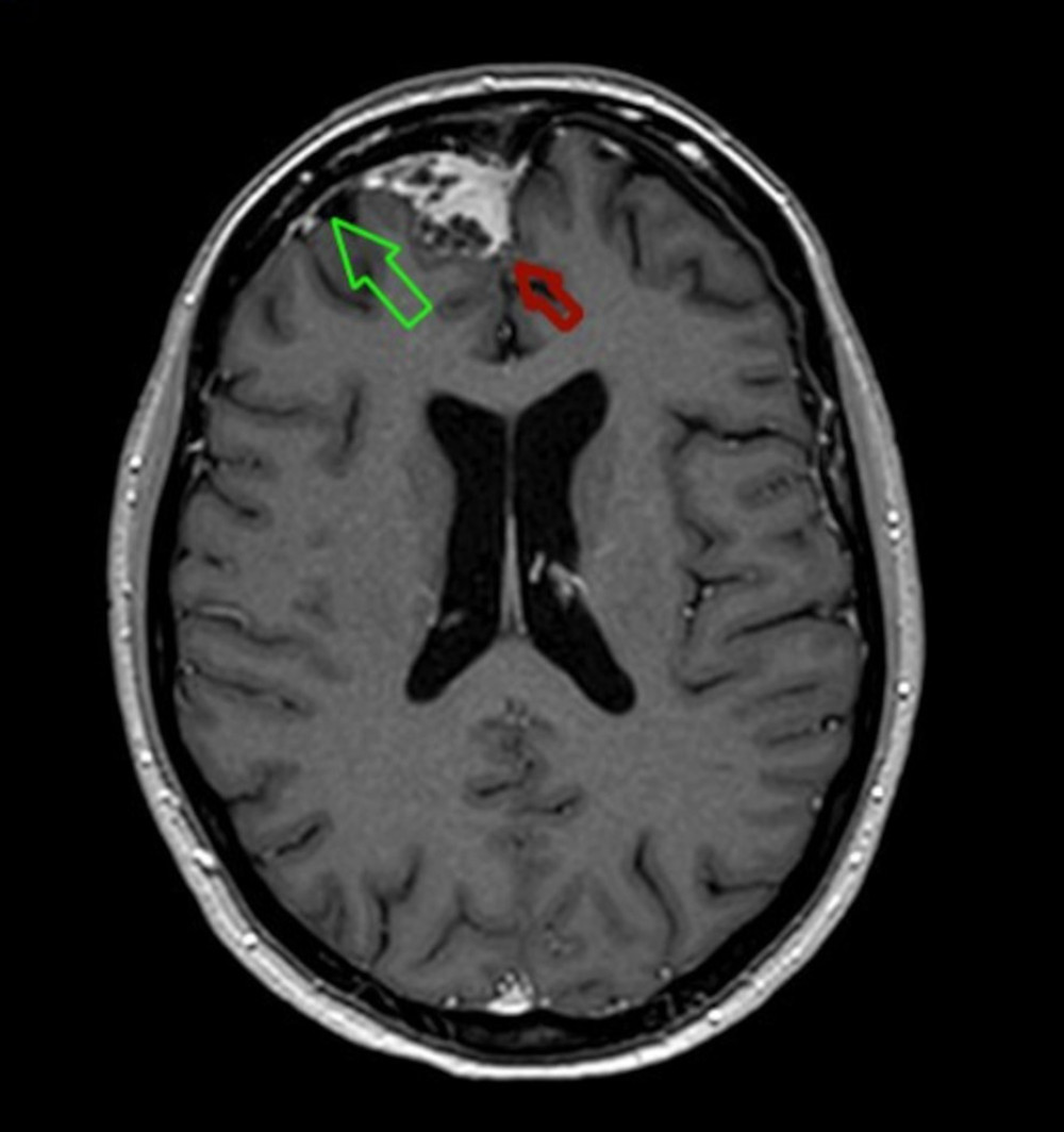 A contrast-enhanced cerebral magnetic resonance imaging section showing the right parafalcine nodular lesion already seen in the direct computed tomography scan (red arrow). Other dural areas of diffuse thickening and enhancement (known as “dural tail sign”) are also visible (green arrow).