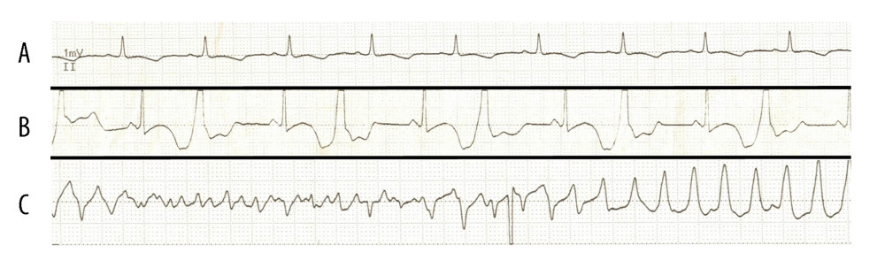 Electrocardiogram demonstrating the progression of the arrythmia. (A) Sinus rhythm with prolonged QT interval. (B) Bigeminy. (C) Ventricular tachycardia with transition to torsades de pointes.