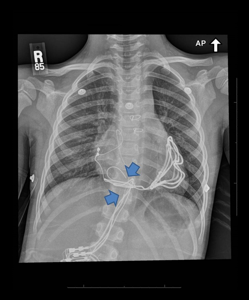 Anterior-posterior radiograph illustrating the fractured leads of the automatic implantable cardioverterdefibrillator (arrows).