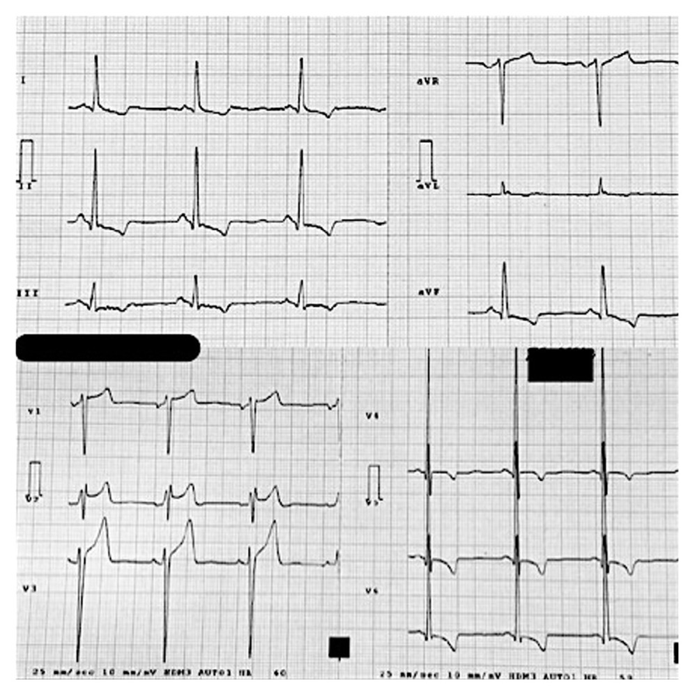 Electrocardiogram showing signs of left ventricular hypertrophy using Sokolow-Lyon criteria.