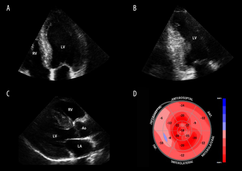 Transthoracic echocardiogram. (A) Apical 4-chamber. (B) Apical 2-chamber. (C) Parasternal long-axis. (D) Polar map (“bullseye”) of global longitudinal strain of the left ventricle with loss of normal base-to-apex strain values, as an early marker of cardiac involvement in Anderson-Fabry disease. AFD – Anderson-Fabry disease; Ao – aorta; GLS – global longitudinal strain; LV – left ventricle; RV – right ventricle.