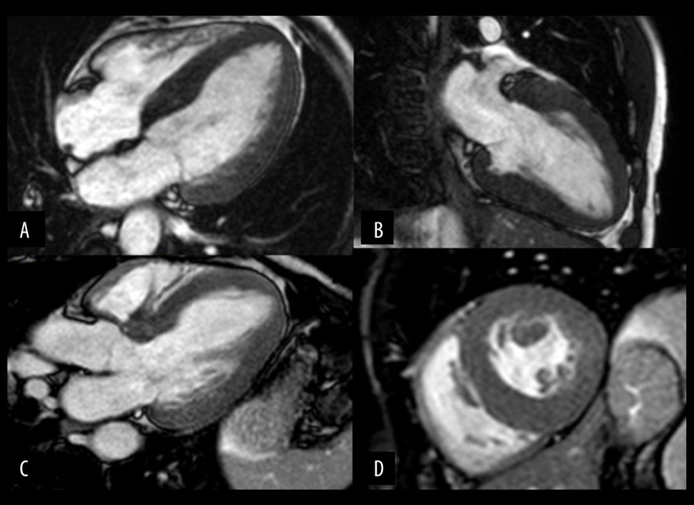 Cardiac magnetic resonance imaging of the index patient. Steady-state free precession (SSFP) cine images at end-diastole. Severe concentric symmetric left ventricular hypertrophy (maximum anteroseptal wall thickness 18 mm vs. 16 mm in the inferolateral wall). (A) 4-chamber view. (B) 2-chamber view. (C) 3-chamber view. (D) Short-axis view.