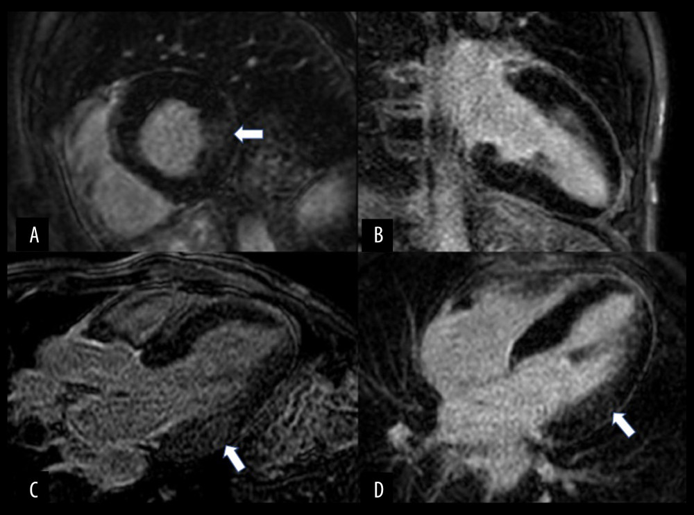 Cardiac magnetic resonance imaging of the index patient. Late gadolinium enhancement study showing mid-wall fibrosis in the basal to mid-lateral segments (white arrow). (A) Basal short-axis view. (B) 2-chamber view. (C) 3-chamber view. (D) 4-chamber view.