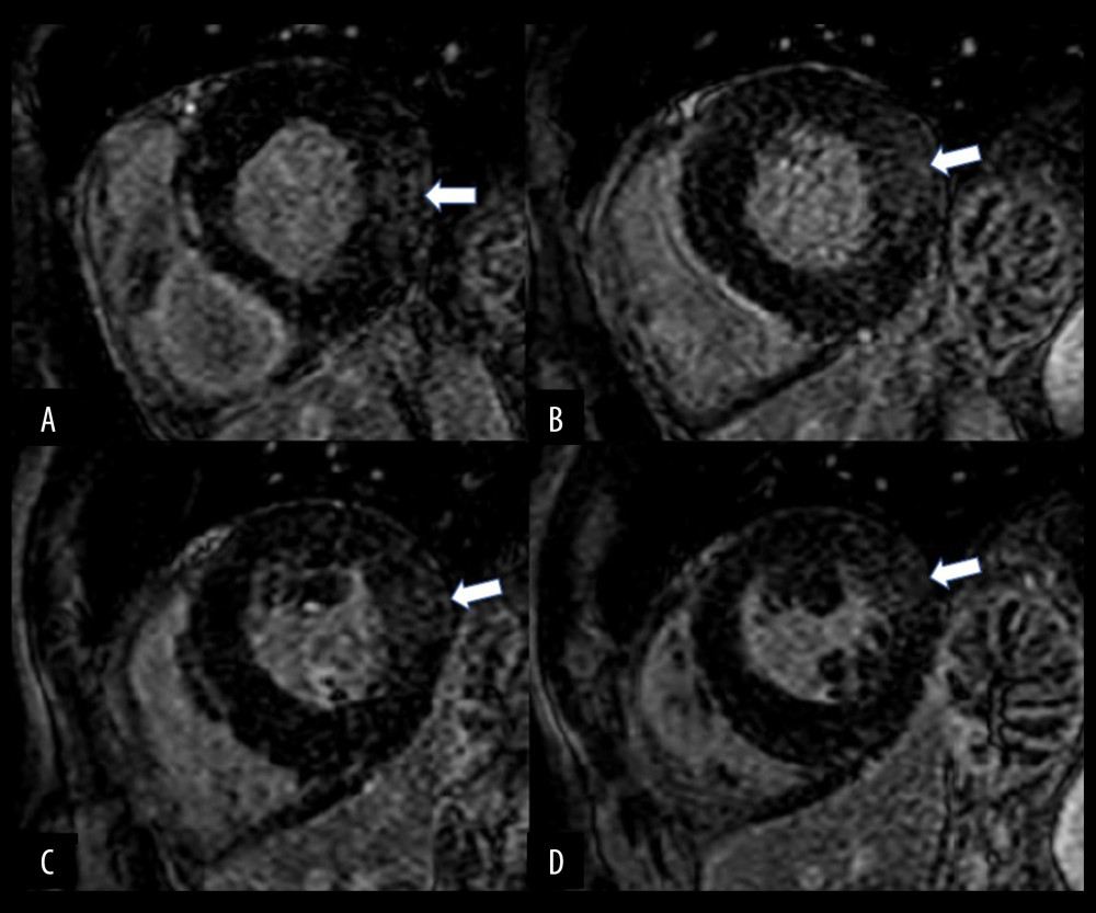 Cardiac magnetic resonance imaging of the index patient. Late gadolinium enhancement study showing mid-wall fibrosis in the basal to mid-lateral segments (white arrow). (A, B) Short-axis view of basal segments. (C, D) Short-axis view of mid-segments.