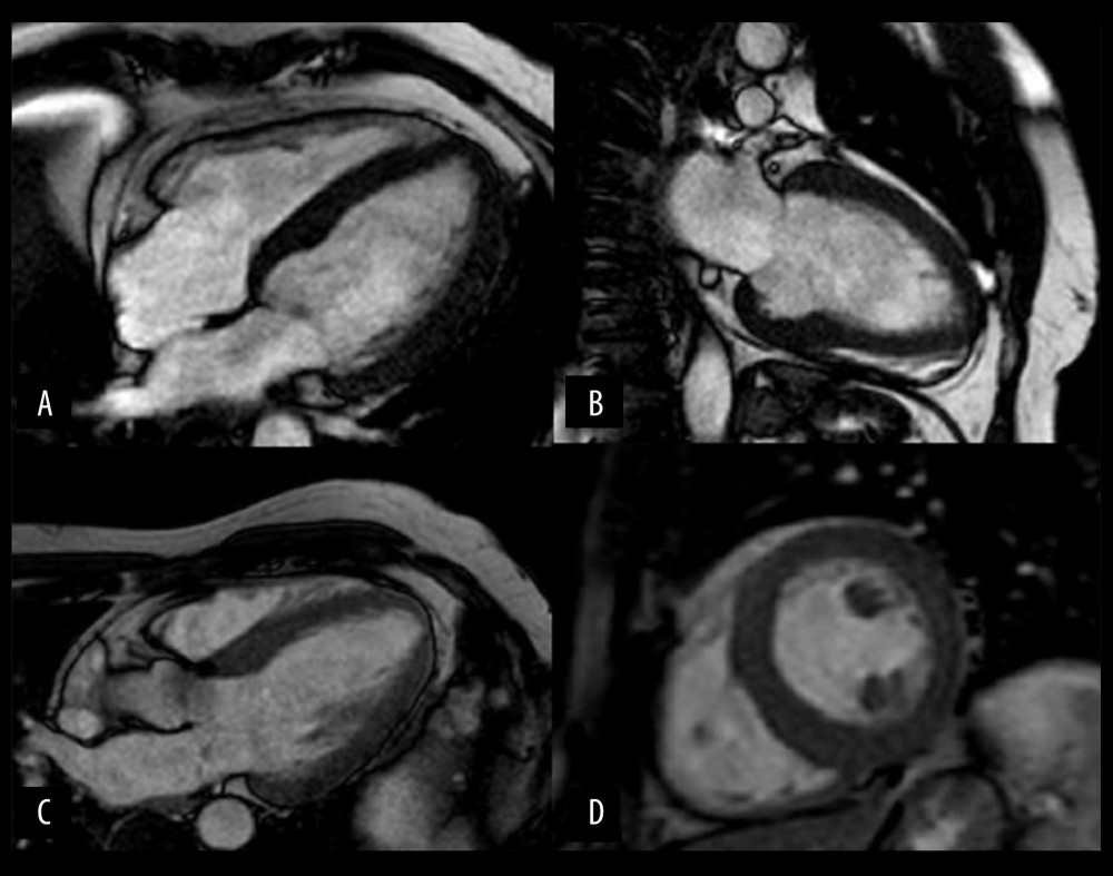Cardiac magnetic resonance imaging of the index patient’s brother. Steady-state free precession cine images at end-diastole. Severe concentric asymmetrical left ventricular hypertrophy (maximum anteroseptal wall thickness 16 mm vs. 11 mm in the inferolateral wall). (A) 4-chamber view. (B) 2-chamber view. (C) 3-chamber view. (D) Short-axis view.