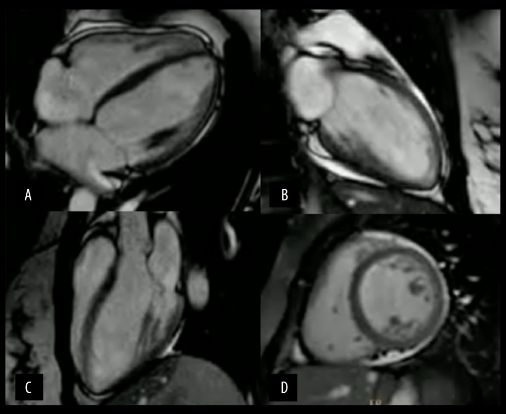 Cardiac magnetic resonance imaging of the index patient’s daughter. Steady-state free precession cine images at enddiastole. Normal volumes, no left ventricular hypertrophy (maximum anteroseptal wall thickness 6 mm vs. 6 mm in the inferolateral wall). (A) 4-chamber view. (B) 2-chamber view. (C) 3-chamber view. (D) Short-axis view.
