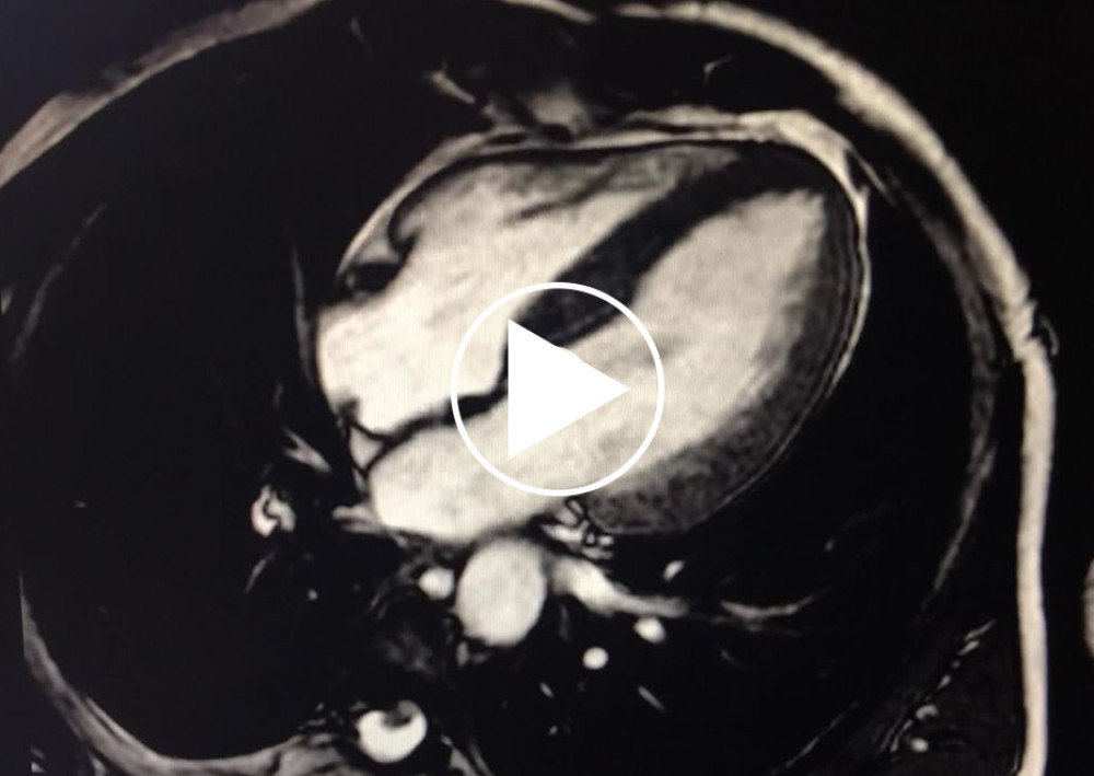 Cardiac magnetic resonance imaging of the index patient. 4-chamber SSFP cine video. Normal biventricular ejection fraction, no regional wall motion abnormalities. Concentric symmetric left ventricular hypertrophy.