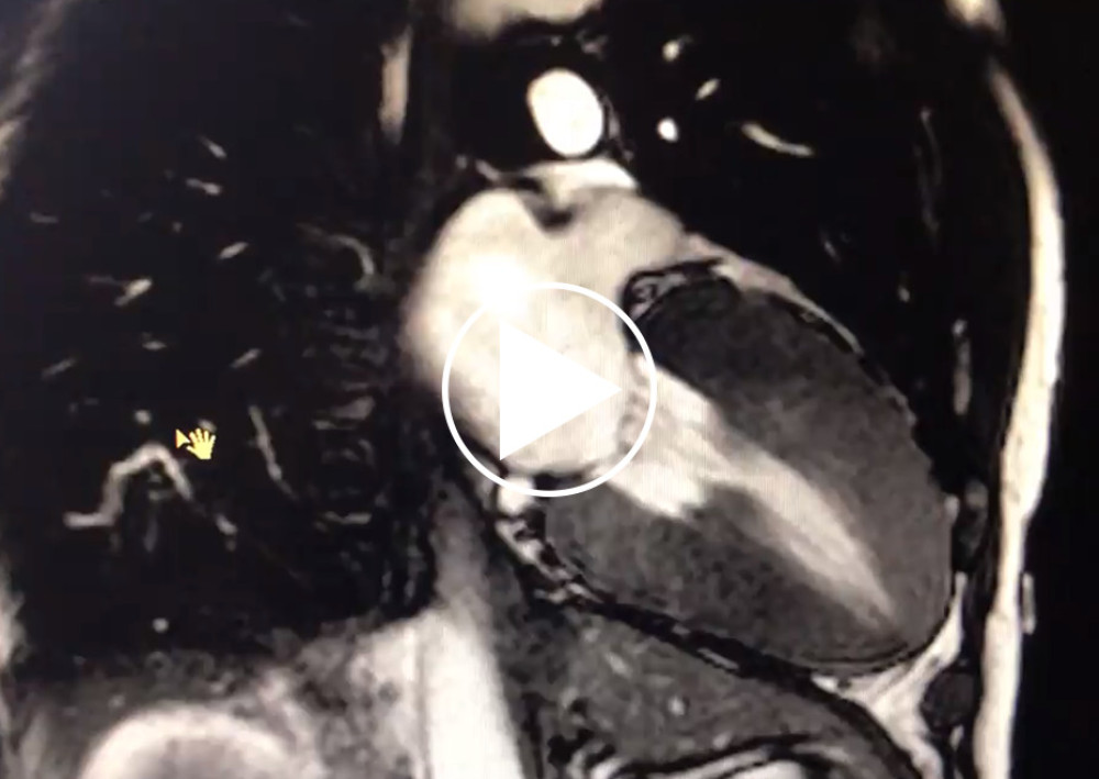 Cardiac magnetic resonance imaging of the index patient. 2-chamber SSFP cine video. Normal left ventricle ejection fraction, no regional wall motion abnormalities.