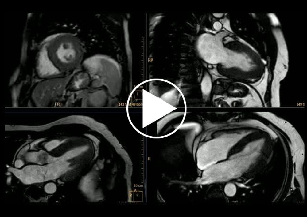 Cardiac magnetic resonance imaging of the index patient’s brother. SSFP cine video at short-axis, 2-chamber, 3-chamber and 4-chamber views. Normal biventricular ejection fraction, no regional wall motion abnormalities. Concentric asymmetrical left ventricular hypertrophy.